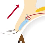 従来の切らない 眼瞼下垂方法 イメージ