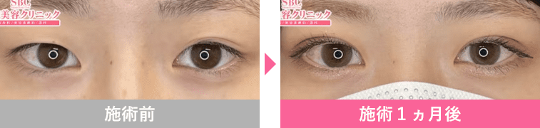 湘南二重術の症例写真