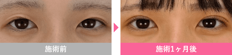 週末二重®の症例写真3