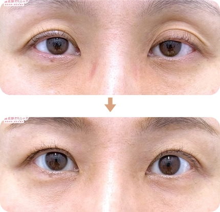 切らない眼瞼下垂 真崎式 Before After(No.363115)