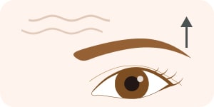 二重埋没法と切らない眼瞼下垂の比較 Q2