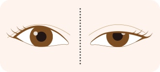 二重埋没法と切らない眼瞼下垂の比較 Q4