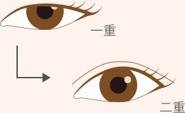 二重埋没法と切らない眼瞼下垂の比較 Q5