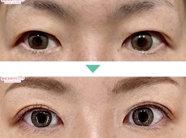 二重埋没法 症例写真1