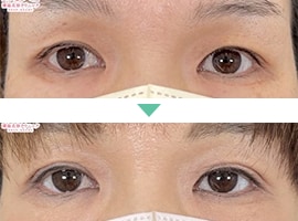 二重埋没法 症例写真2