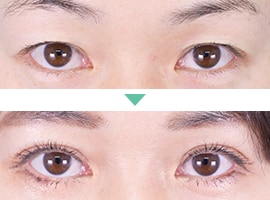 二重埋没法 症例写真8
