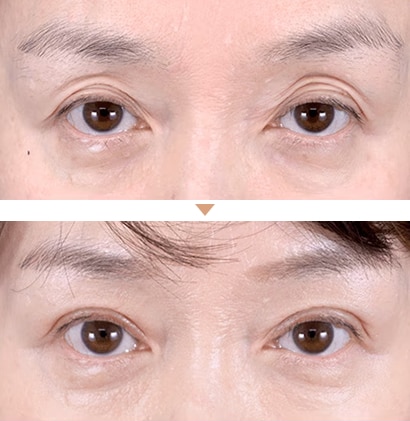 切らない眼瞼下垂 真崎式 症例写真2