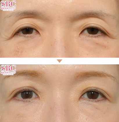 切らない眼瞼下垂 真崎式 症例写真3(No.366190)