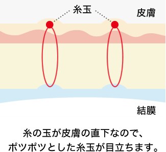 通常の埋没法