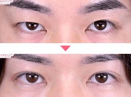 男性二重・目元整形症例写真1