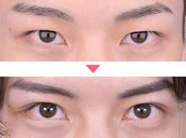 男性二重・目元整形症例写真2