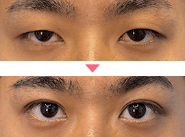 男性二重・目元整形症例写真3