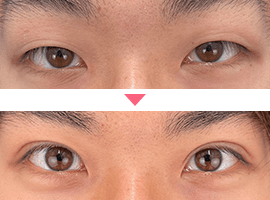 男性二重・目元整形症例写真4
