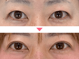 40代以上女性二重・目元整形症例写真2