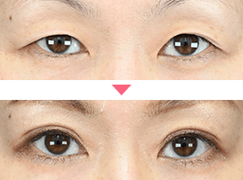 40代以上女性二重・目元整形症例写真3