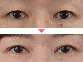 40代以上女性二重・目元整形症例写真4