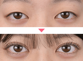 10代女性二重・目元整形症例写真1
