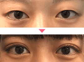10代女性二重・目元整形症例写真2