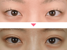 10代女性二重・目元整形症例写真3