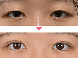 10代女性二重・目元整形症例写真4