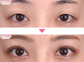 20代~30代女性二重・目元整形症例写真2