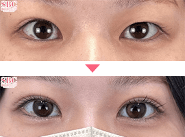 20代~30代女性二重・目元整形症例写真3