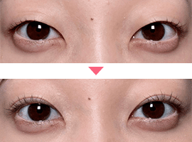 20代~30代女性二重・目元整形症例写真4
