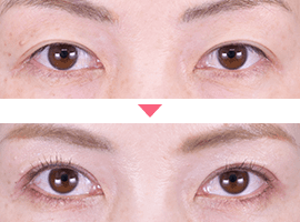 20代~30代女性二重・目元整形症例写真5