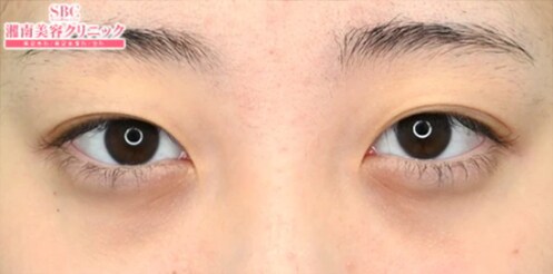 症例300111B
