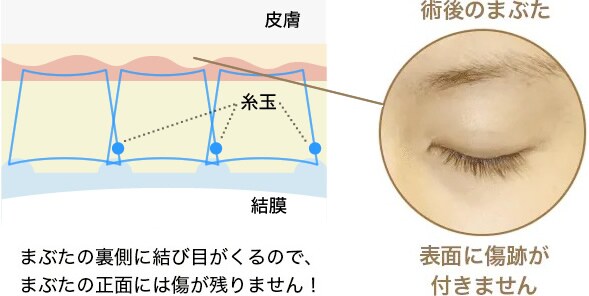 クイックコスメティーク・トリプルneoの糸玉