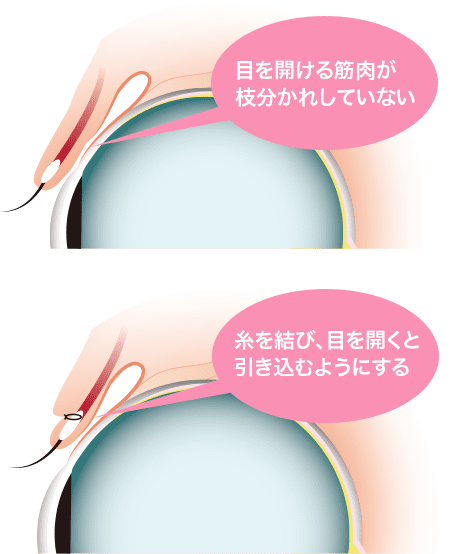 クイックコスメティーク ダブルneo 二重 目元整形なら湘南美容クリニック 公式
