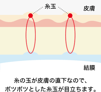 通常の埋没法の糸玉