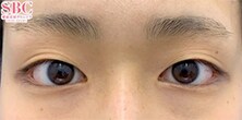 術前