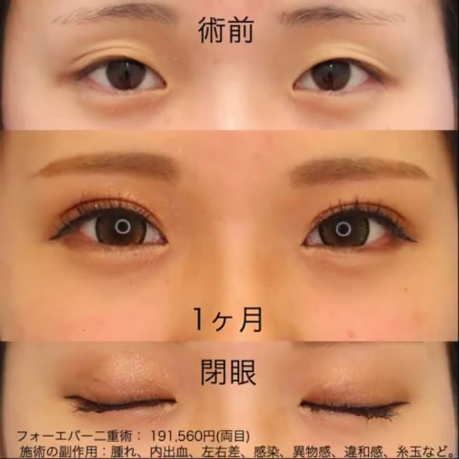 二重術セレクション 二重 目元整形なら湘南美容クリニック 公式 二重術セレクション 二重 目元整形なら湘南美容クリニック 公式