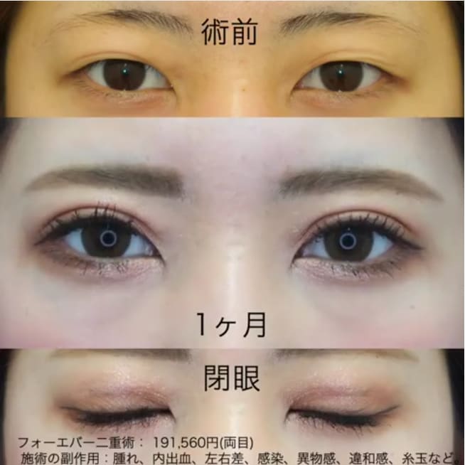 二重術セレクション 二重 目元整形なら湘南美容クリニック 公式 二重術セレクション 二重 目元整形なら湘南美容クリニック 公式