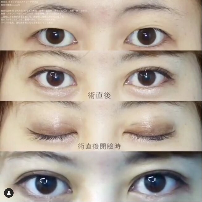 二重術セレクション 二重 目元整形なら湘南美容クリニック 公式