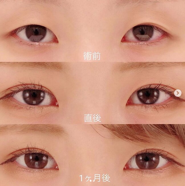 二重術セレクション 二重 目元整形なら湘南美容クリニック 公式