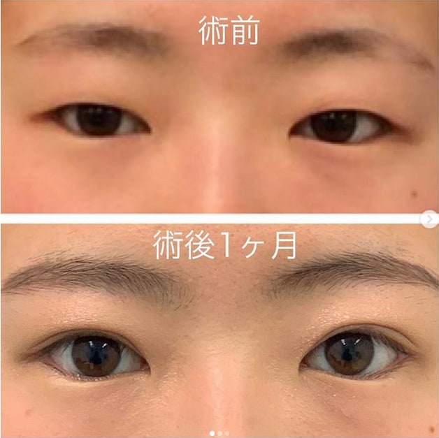 二重術セレクション 二重 目元整形なら湘南美容クリニック 公式