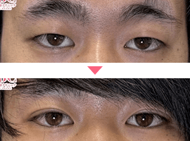 男性二重・目元整形症例写真2