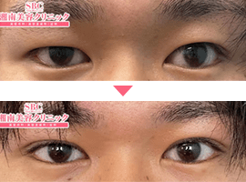 男性二重・目元整形症例写真3