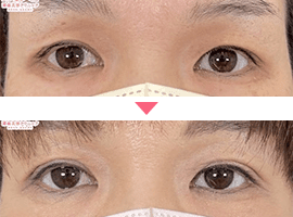 40代以上女性二重・目元整形症例写真2