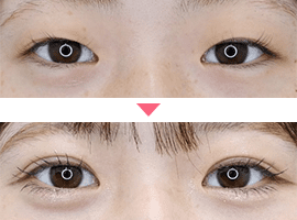 10代女性二重・目元整形症例写真1