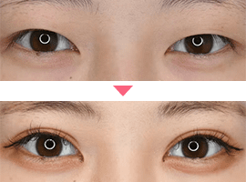 20代～30代女性二重・目元整形症例写真2