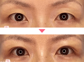 20代～30代女性二重・目元整形症例写真3