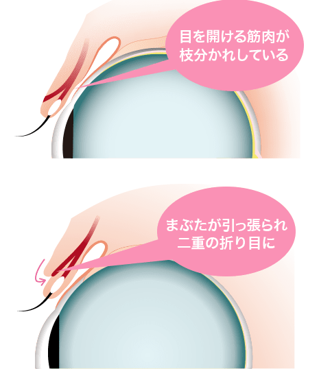 二重まぶた