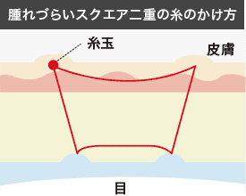 腫れづらいスクエア二重術の仕組み