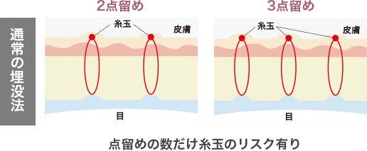 通常の埋没法