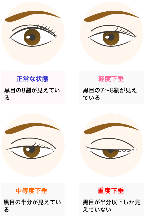 眼瞼下垂 二重 目元整形なら湘南美容クリニック 公式 眼瞼下垂 二重 目元整形なら湘南美容クリニック 公式