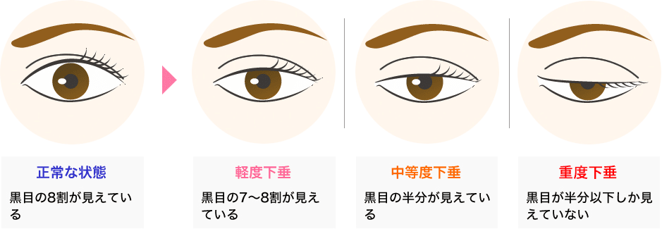 眼瞼下垂 二重 目元整形なら湘南美容クリニック 公式 眼瞼下垂 二重 目元整形なら湘南美容クリニック 公式