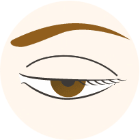 眼瞼下垂の重症度分類｛重度下垂｝